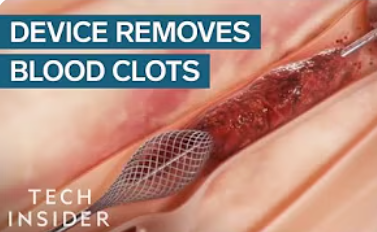 How This Device Safely Removes Blood Clots
